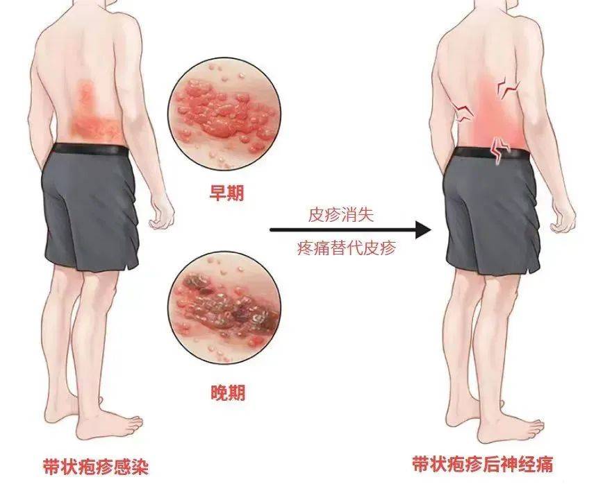 皇冠信用网登2代理_一旦感染终身携带皇冠信用网登2代理!深圳疾控提醒:这4类人要注意