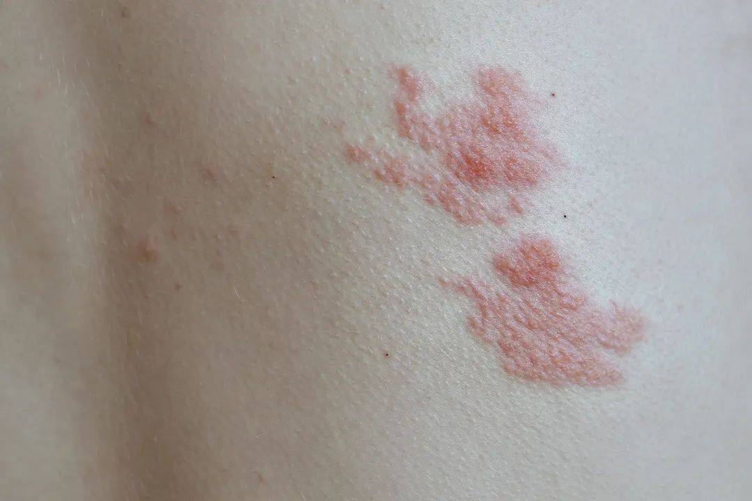 皇冠信用网登2代理_一旦感染终身携带皇冠信用网登2代理!深圳疾控提醒:这4类人要注意