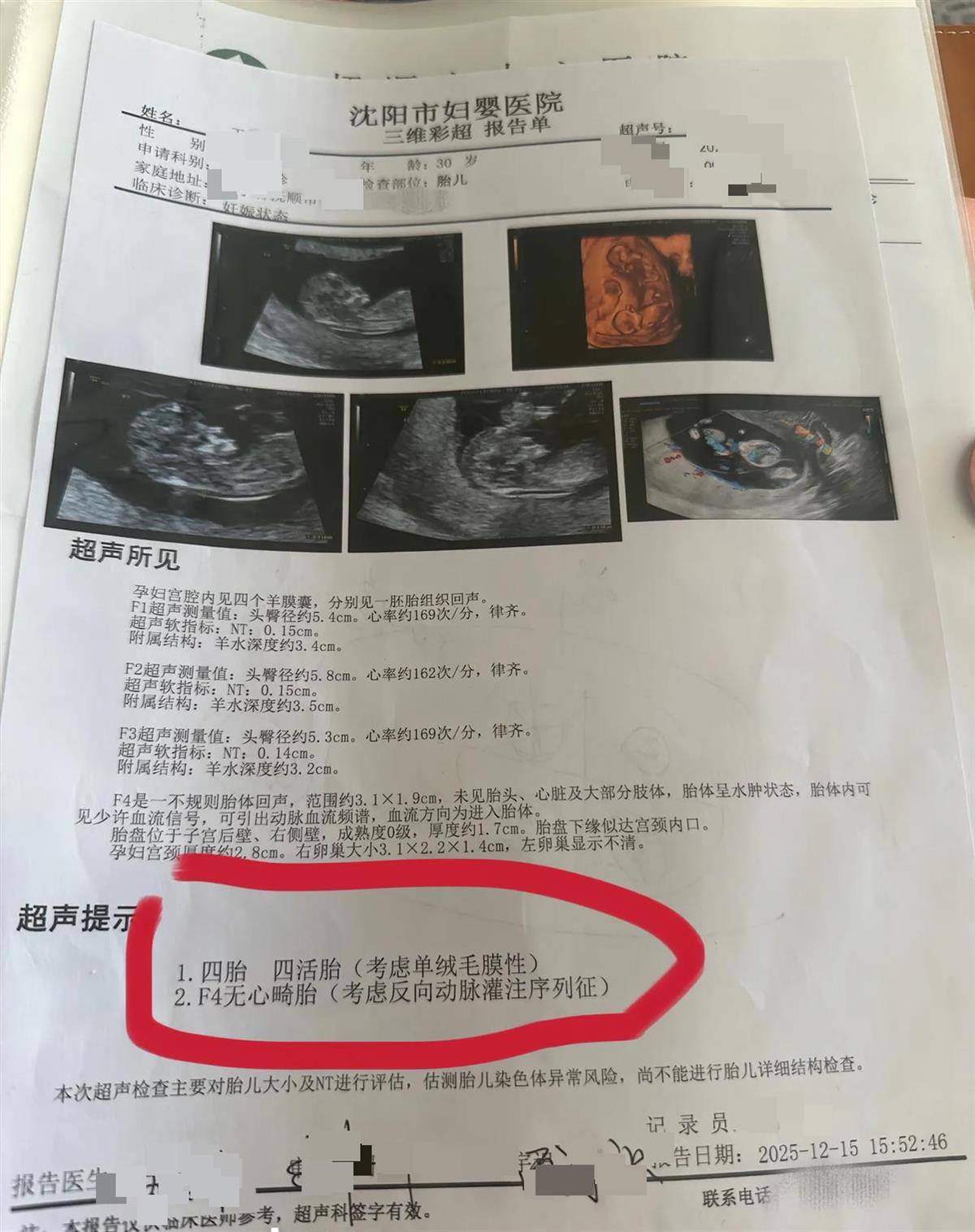 洛斯查兰特vs域堡
_辽宁一孕妇两个月内从一胎变四胞胎洛斯查兰特vs域堡
,每次产检发现多出一胎,医生:系同卵四胞胎,概率1300万至1500万分之一